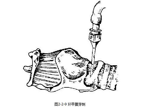 环甲膜穿刺术.jpg
