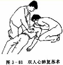 双人心肺复苏术