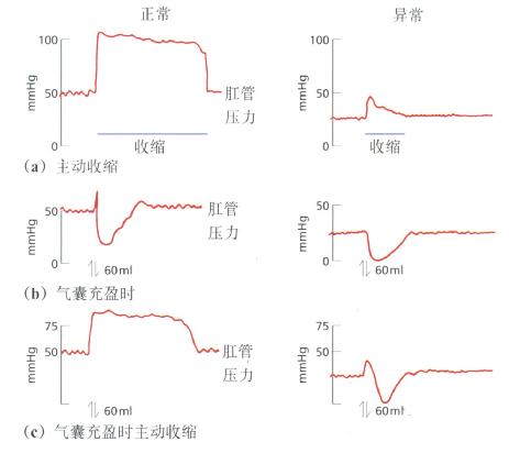 一例肛门外括约肌功能减弱患儿与正常儿童肛门直肠测压