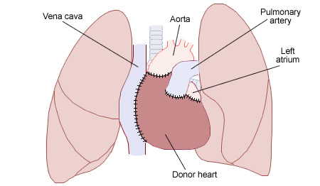 文件:Heart transplant.jpg