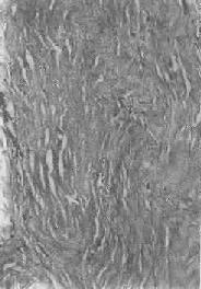 纤维瘢痕组织的玻璃样变