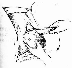 脐带绕颈自头部滑下