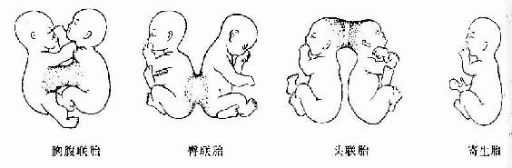 联胎的类型