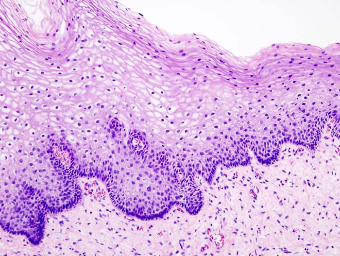 文件:Cervical intraepithelial neoplasia (1) normal squamous epithelium.jpg