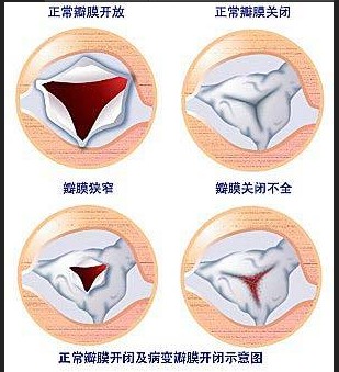 文件:瓣膜异常.jpg
