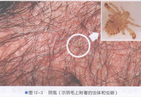 文件:阴虱病.jpg