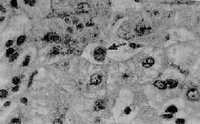 急性病毒性肝炎