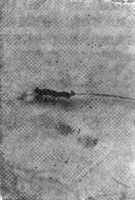 导管穿过栓子，取出的血栓