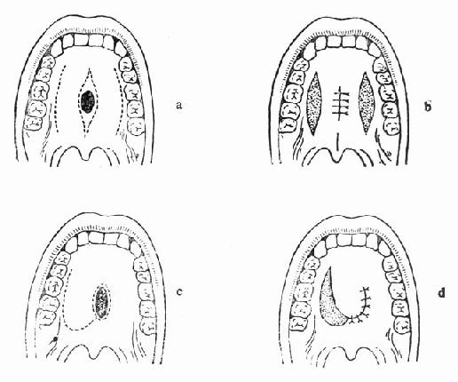 硬腭组织缺损的处理