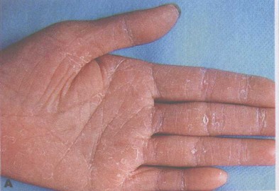 手癣.jpg