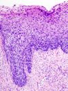 Cervical intraepithelial neoplasia (4) CIN3.jpg