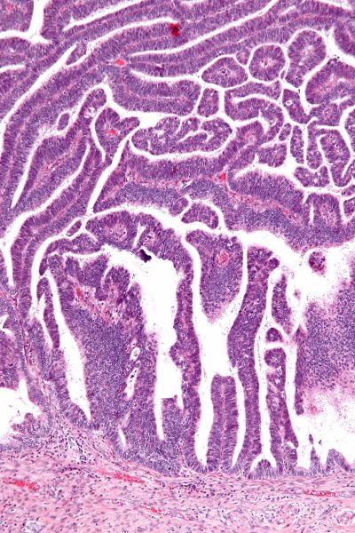 文件:Villoglandular adenocarcinoma - intermed mag.jpg