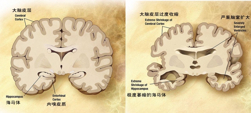 文件:Alzheimer's disease brain comparison.jpg