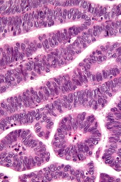 文件:Villoglandular adenocarcinoma - very high mag.jpg